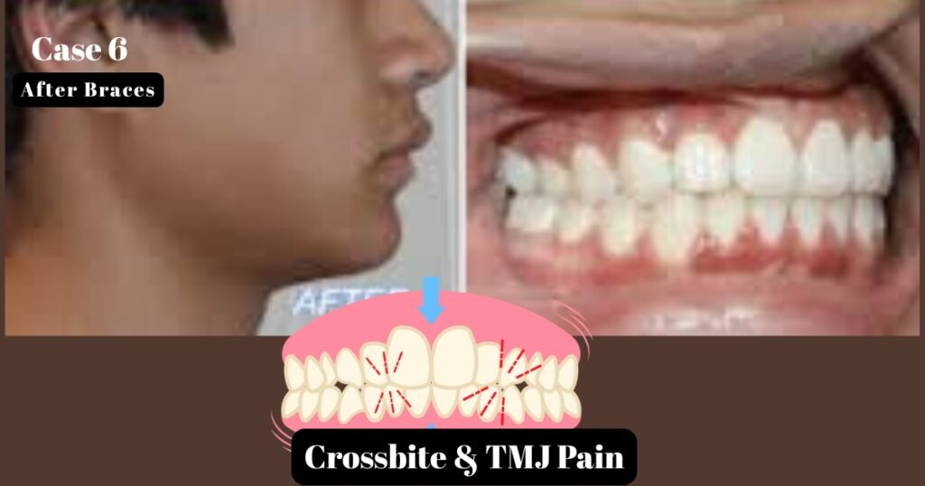 Before and After Braces: A Complete Transformation Guide 20 Before and After Braces