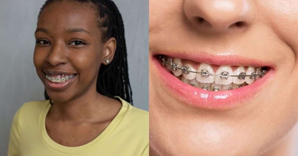 Silver Braces: Why They’re Still a Popular Choice for Straightening Teeth 5 Silver Braces