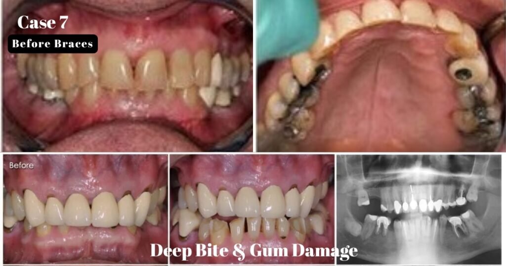 Before and After Braces: A Complete Transformation Guide 21 Before and After Braces
