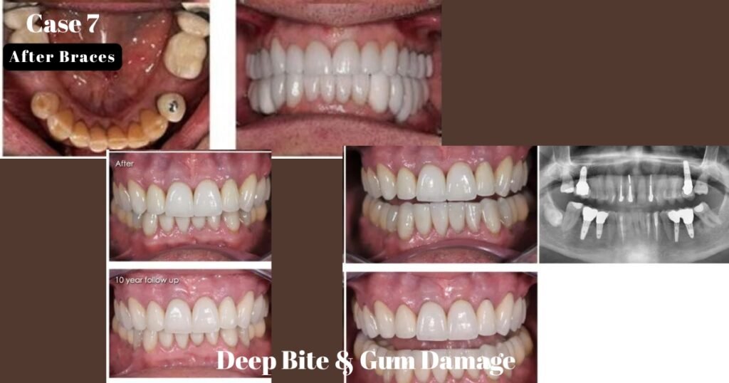 Before and After Braces: A Complete Transformation Guide 22 Before and After Braces