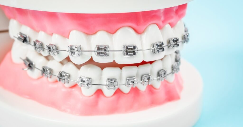 Silver Braces: Why They’re Still a Popular Choice for Straightening Teeth 7 Silver Braces