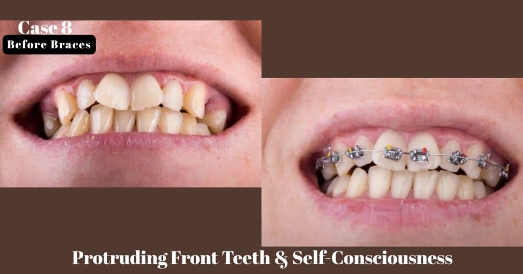 Before and After Braces: A Complete Transformation Guide 23 Before and After Braces