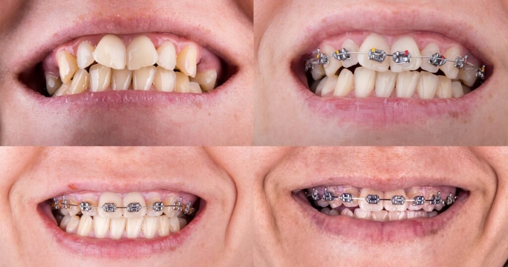 Silver Braces: Why They’re Still a Popular Choice for Straightening Teeth 8 Silver Braces