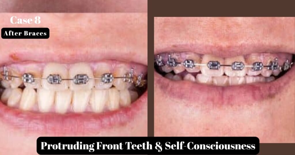Before and After Braces: A Complete Transformation Guide 24 Before and After Braces