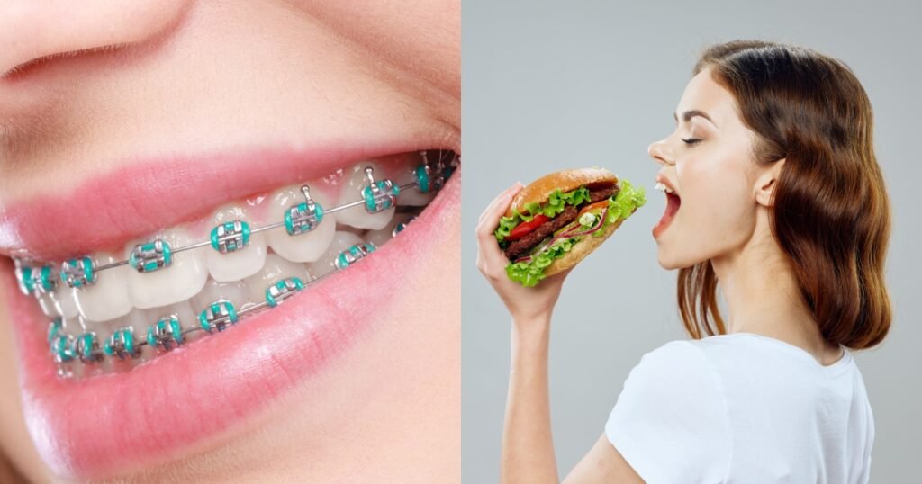 Can You Eat a Burger with Braces? 5 Tips to Enjoy Without Worry 4 Can You Eat a Burger with Braces