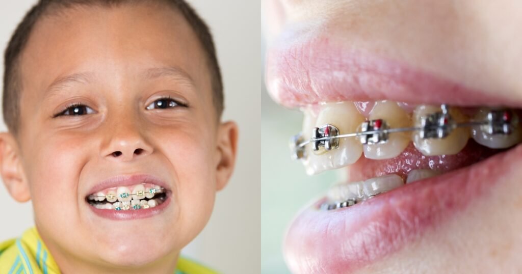 Silver Braces: Why They’re Still a Popular Choice for Straightening Teeth 9 Silver Braces