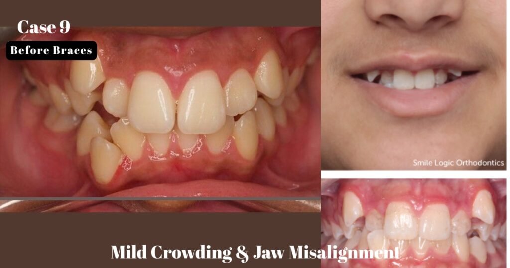 Before and After Braces: A Complete Transformation Guide 25 Before and After Braces