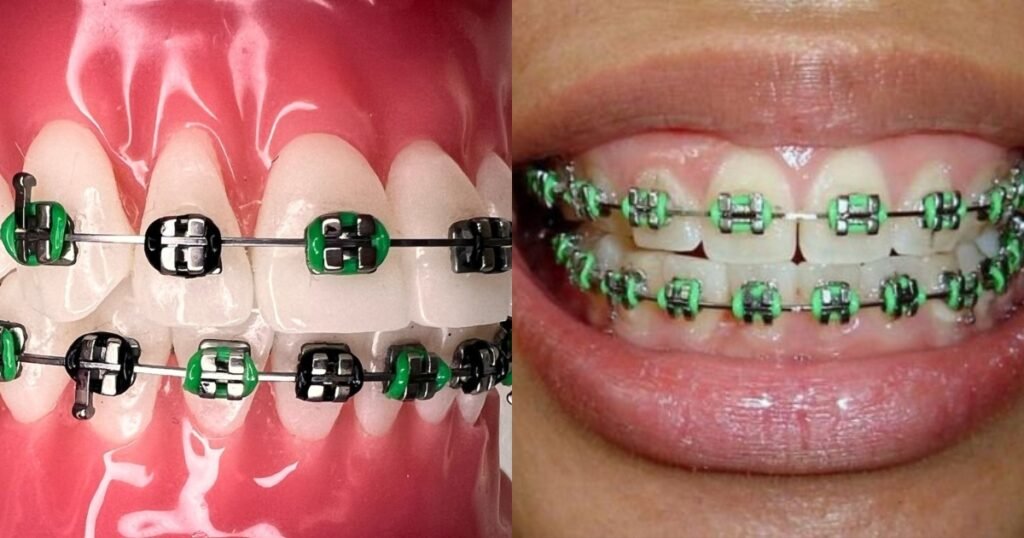 Green Braces: Are They Right for You? Pros, Cons, and Most valuable Tips! 3 Green Braces