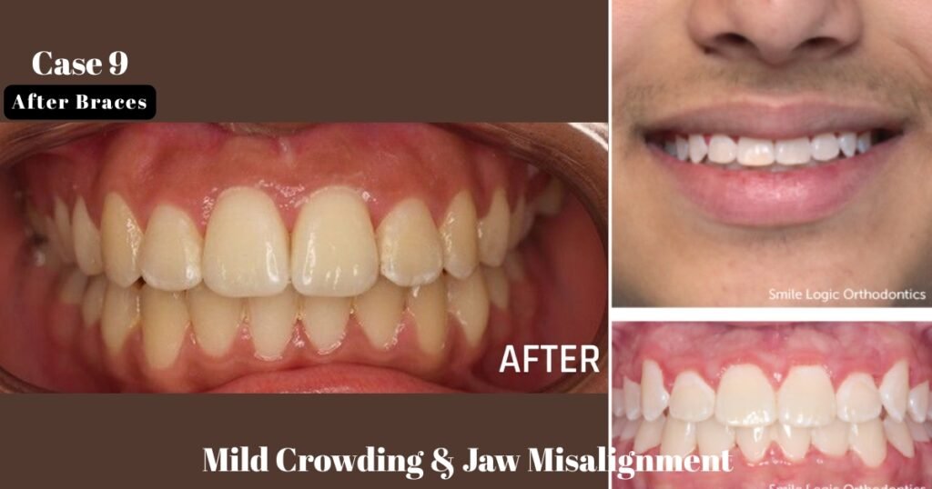 Before and After Braces: A Complete Transformation Guide 26 Before and After Braces