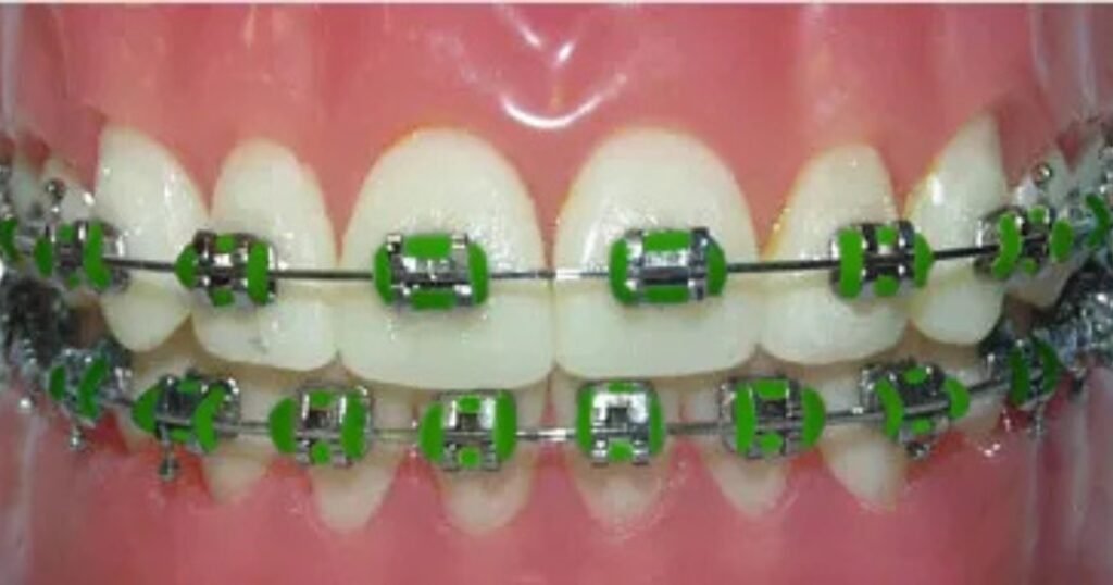 Green Braces: Are They Right for You? Pros, Cons, and Most valuable Tips! 4 Green Braces