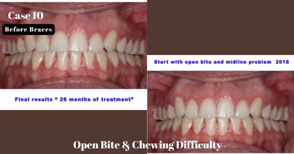 Before and After Braces: A Complete Transformation Guide 27 Before and After Braces