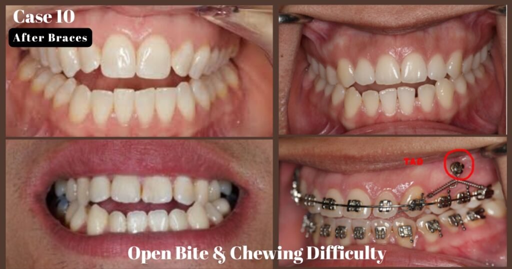 Before and After Braces: A Complete Transformation Guide 28 Before and After Braces