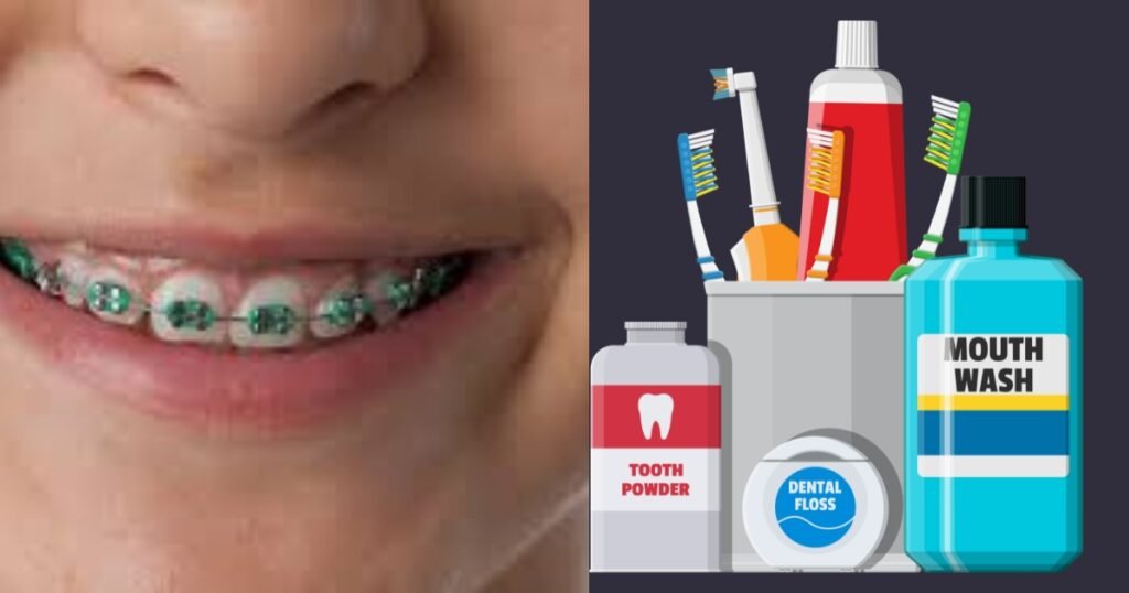 Green Braces: Are They Right for You? Pros, Cons, and Most valuable Tips! 6 Green Braces