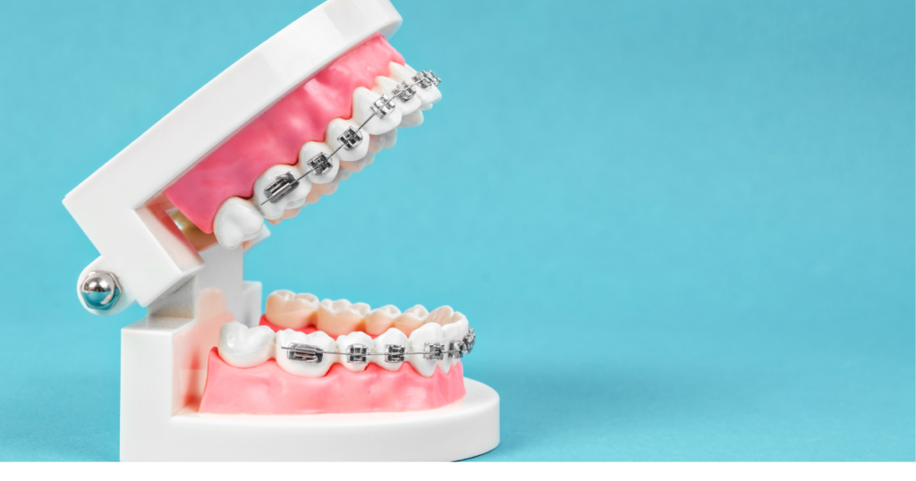 Best Braces Cost Estimator 2025 - Find Your Personalized Braces Cost in 60 Seconds 4 Braces Cost Estimator