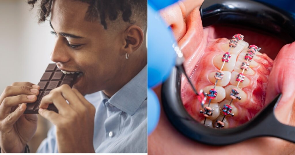 Can You Eat Chocolate with Braces? A Complete Guide 4 Can You Eat Chocolate with Braces