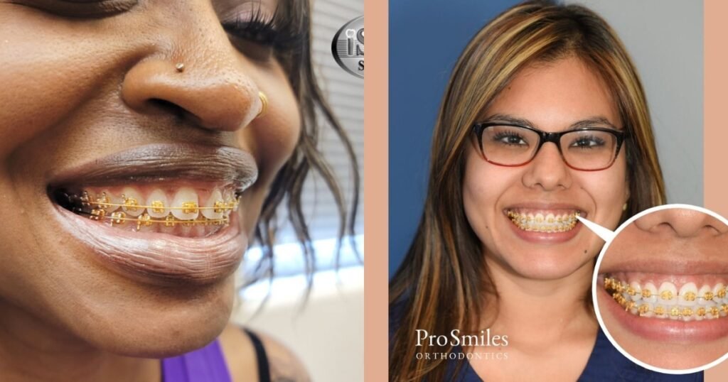 Gold Braces: The Ultimate Guide to Style, Cost, and Benefits 3 Gold Braces