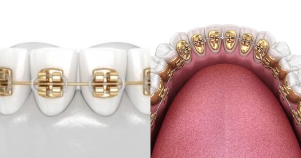 Gold Braces: The Ultimate Guide to Style, Cost, and Benefits 4 Gold Braces