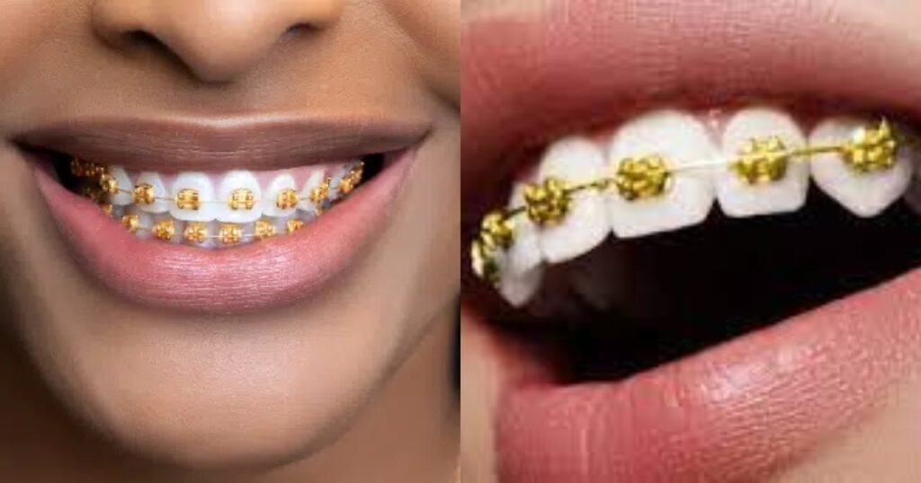 Gold Braces: The Ultimate Guide to Style, Cost, and Benefits 5 Gold Braces