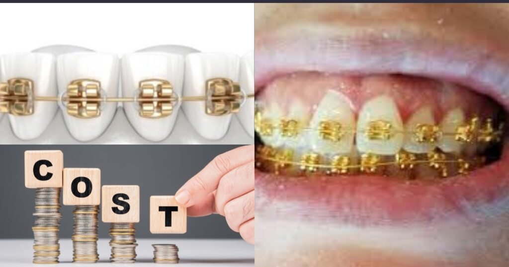Gold Braces: The Ultimate Guide to Style, Cost, and Benefits 6 Gold Braces