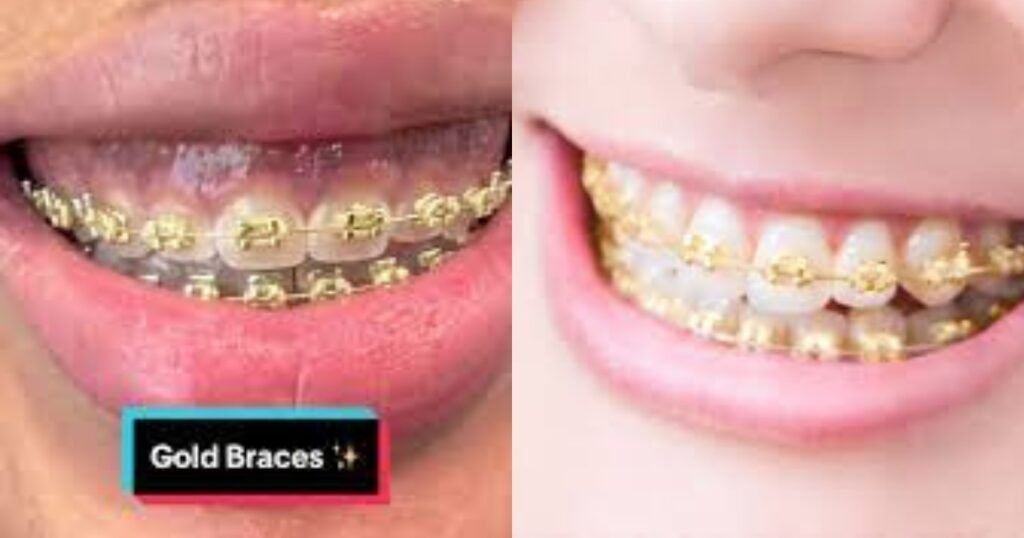Gold Braces: The Ultimate Guide to Style, Cost, and Benefits 7 Gold Braces