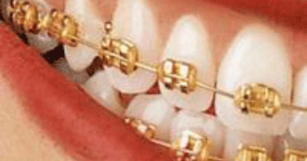 Gold Braces: The Ultimate Guide to Style, Cost, and Benefits 8 Gold Braces