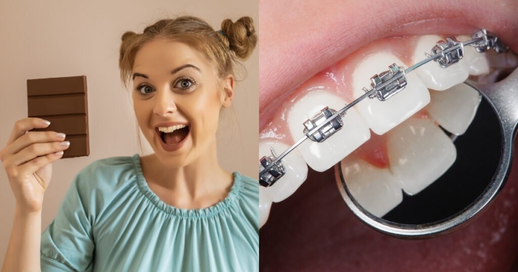 Can You Eat Chocolate with Braces? A Complete Guide 5 Can You Eat Chocolate with Braces