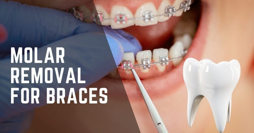 Molar Removal for Braces