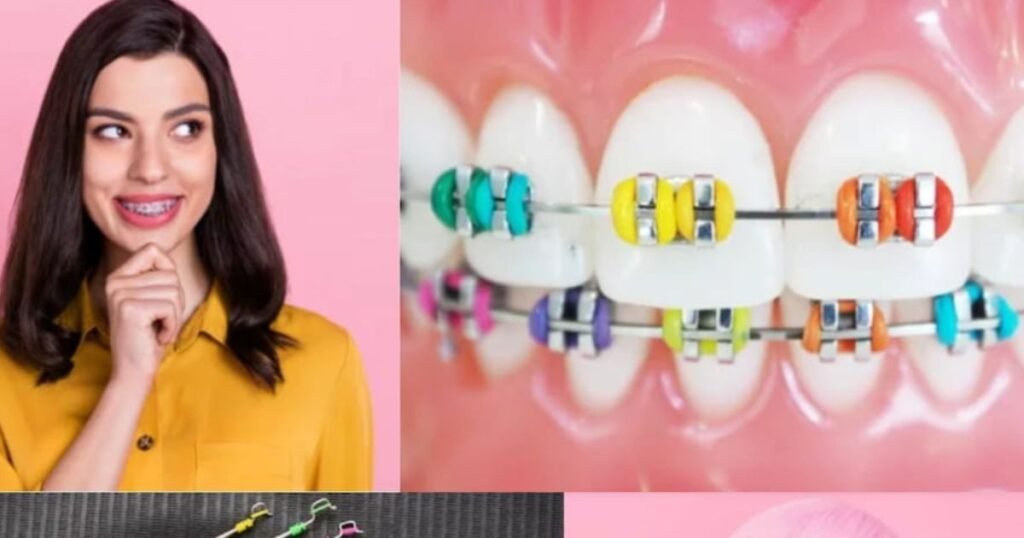 Lavender Braces: The Trendy Way to Add Style to Your Smile! 4 Lavender Braces