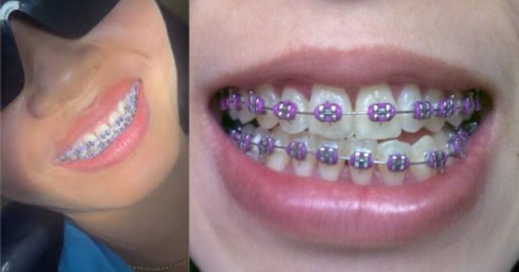 Lavender Braces: The Trendy Way to Add Style to Your Smile! 8 Lavender Braces