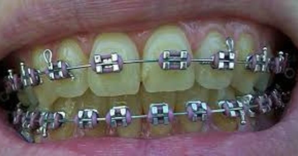 Lavender Braces: The Trendy Way to Add Style to Your Smile! 9 Lavender Braces