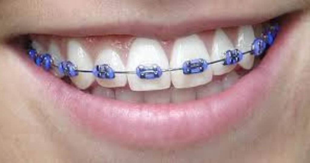 Lavender Braces: The Trendy Way to Add Style to Your Smile! 10 Lavender Braces