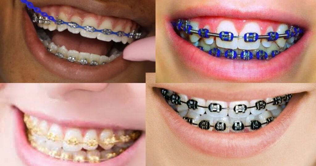 Lavender Braces: The Trendy Way to Add Style to Your Smile! 12 Lavender Braces