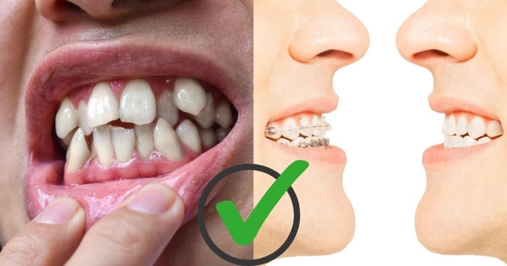 Molar Removal for Braces: 11 Life-Changing Benefits Before Treatment 3 Molar Removal for Braces