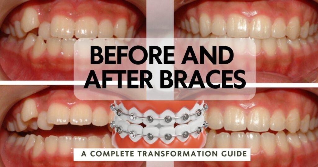 Before and After Braces