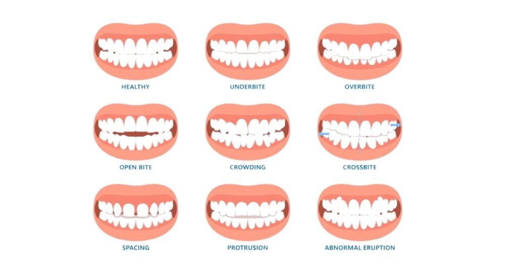 Before and After Braces: A Complete Transformation Guide 4 Before and After Braces