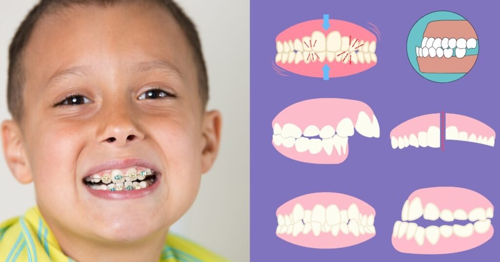Braces at Age 8: Is Early Orthodontic Treatment Right for Your Child? 4 Braces at Age 8