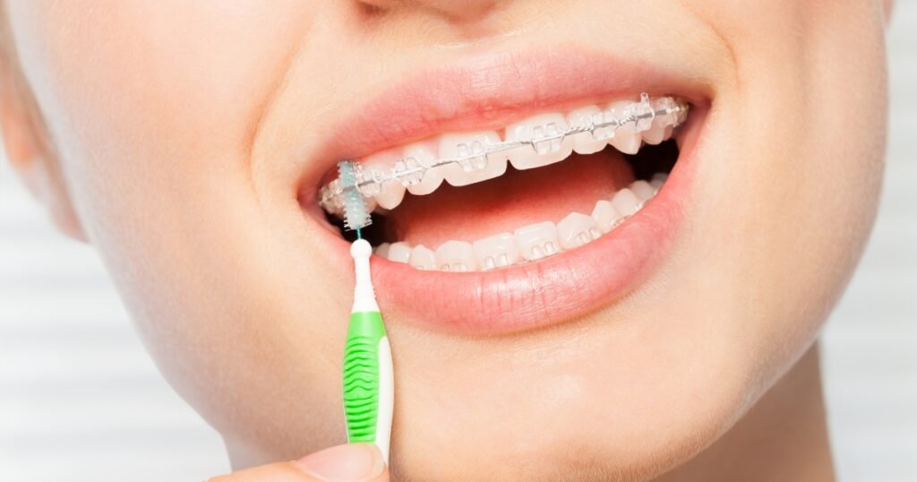Can You Eat Chicken with Braces? 6 Can You Eat Chicken with Braces?