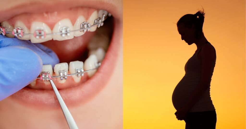 Can You Get Braces While Pregnant? 101 best Guide for Expecting Moms 5 Can You Get Braces While Pregnant
