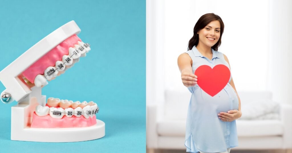Can You Get Braces While Pregnant? 101 best Guide for Expecting Moms 6 Can You Get Braces While Pregnant
