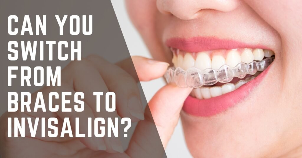 Can You Switch from Braces to Invisalign