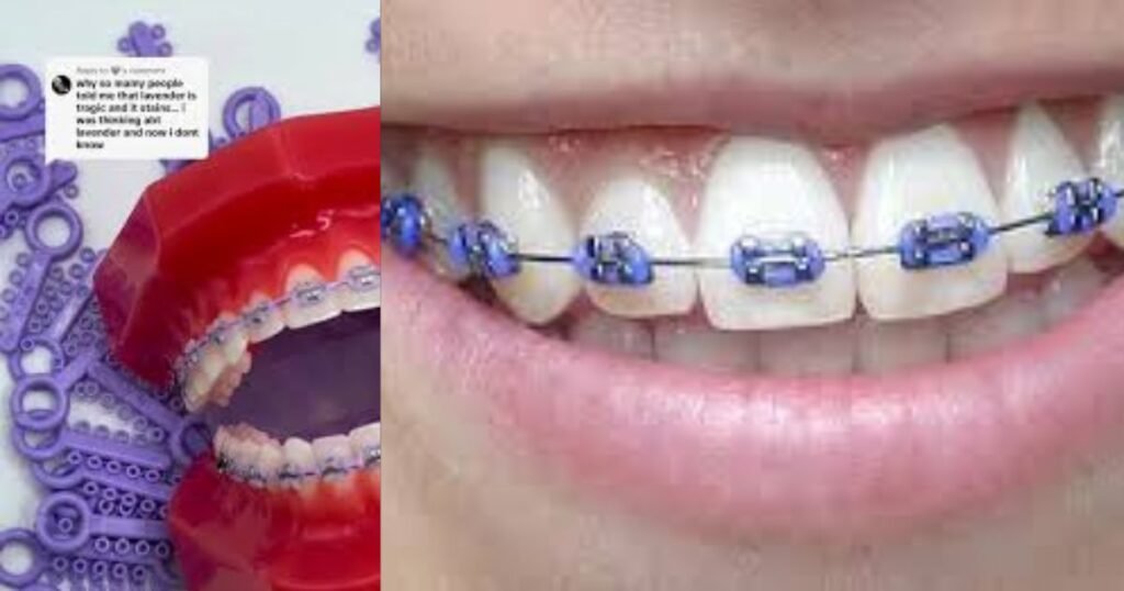 Lavender Braces: The Trendy Way to Add Style to Your Smile! 3 Lavender Braces