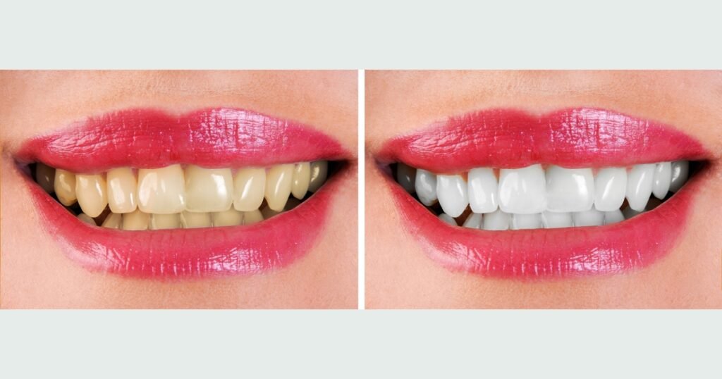 top Tooth Whitening Risk calculator 2025: Find Out If tooth whitening is Safe for Youor not. 4 Tooth Whitening Risk calculator
