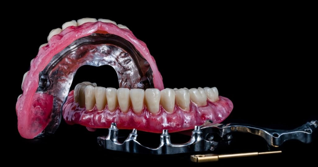 All on 4 Dental Implants: The Ultimate Solution for Full-Arch Restoration 3 All on 4 Dental Implants