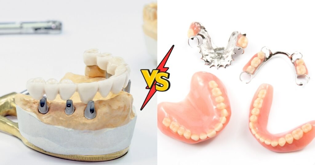 All on 4 Dental Implants: The Ultimate Solution for Full-Arch Restoration 4 All on 4 Dental Implants