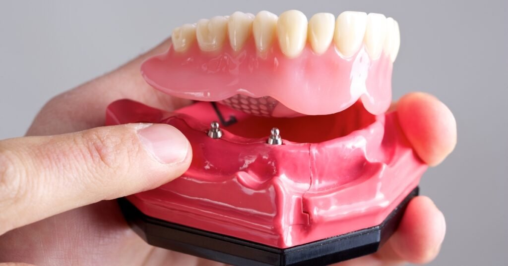 All on 4 Dental Implants: The Ultimate Solution for Full-Arch Restoration 6 All on 4 Dental Implants