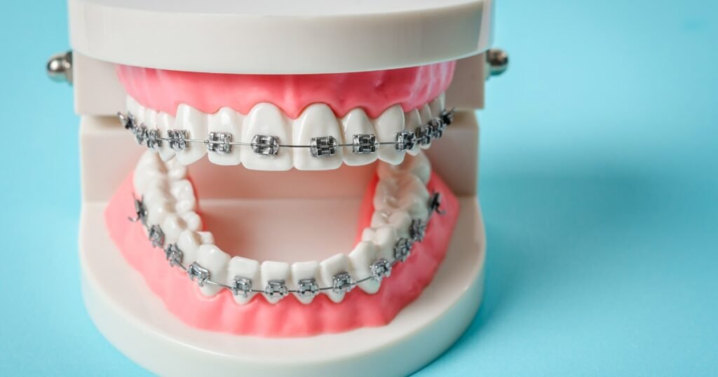 How to Know If You Need Braces: 11 Point Detailed Guide 3 How to Know If You Need Braces