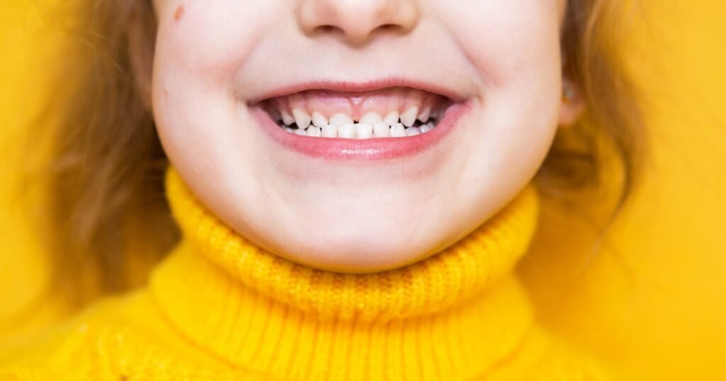 How to Know If You Need Braces: 11 Point Detailed Guide 4 How to Know If You Need Braces