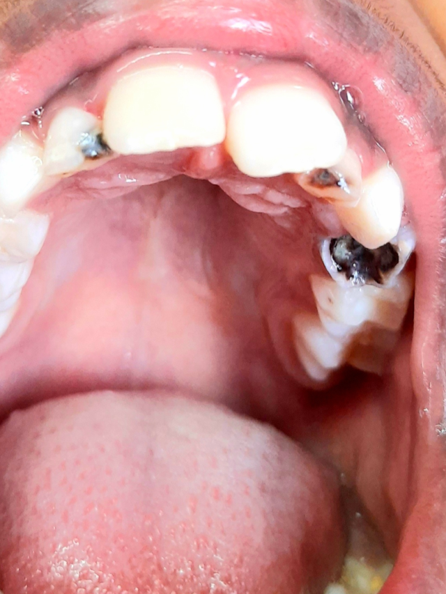 Tooth Decay: What You Need to Know & How to Fight It